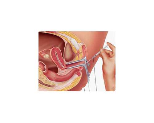 怀孕膀胱压迫感怎么治疗~代怀包儿子