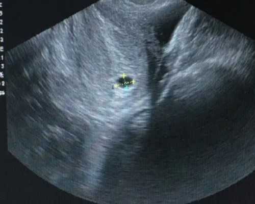 做供卵试管被中介骗的经历&试管可以选性别吗,备孕指南|带你了解HCG:HCG值的高