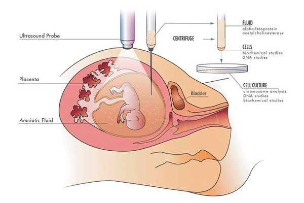合法代怀公司_宫腔积液如何影响辅助生殖技术中助孕过程？